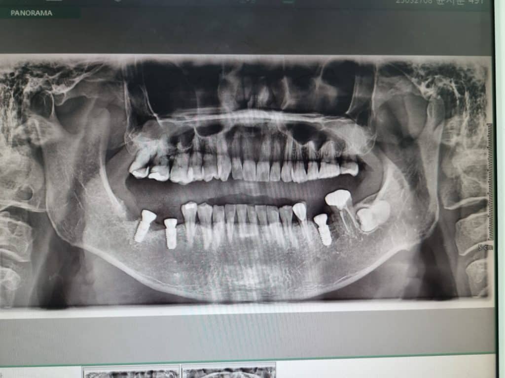 임플란트 수술 후