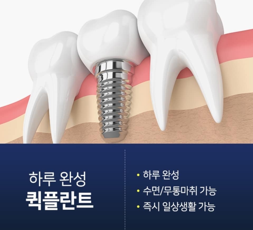 성남 임플란트 신흥역과 수진역 중간에 위치한 서울플러스치과 리뷰 4 성남 임플란트 서울플러스치과 퀵플란트