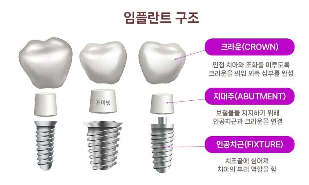 임플란트 구조