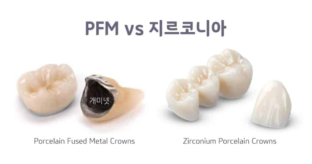 PFM 크라운 vs 지르코니아 크라운