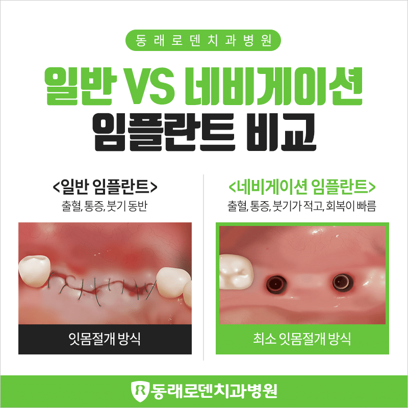 네비게이션 임플란트 가격 및 원데이 임플란트 수술과 비교 분석 .feat 디지털 1 네비게이션 임플란트 vs 일반 임플란트 비교