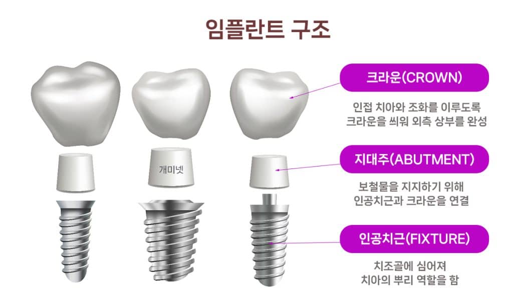 임플란트 지대주 - 어버트먼트 뜻과 맞춤형 지대주와 구조는? 1 임플란트 구조